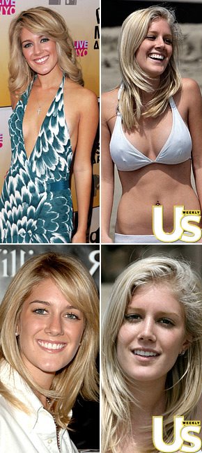 heidi montag surgery before after. heidi-montag-efore-and-after